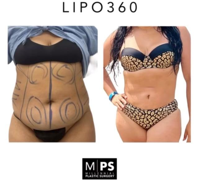 lipo c vs ozempic with Semaglutide: Safety, Risks & Better Alternatives Lipo-C (SlimShot)